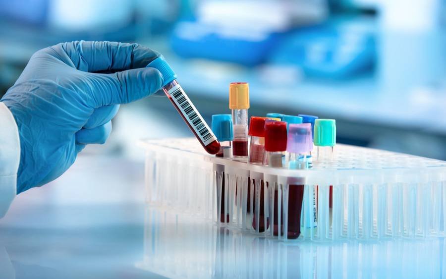 Hepatitis B Virus (HBV) HbsAg-Quantitative Surface Antigen
